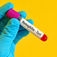 Symptoms of hemophilia