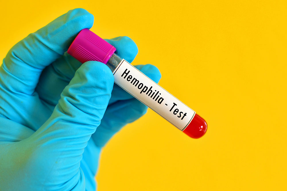 Symptoms of hemophilia