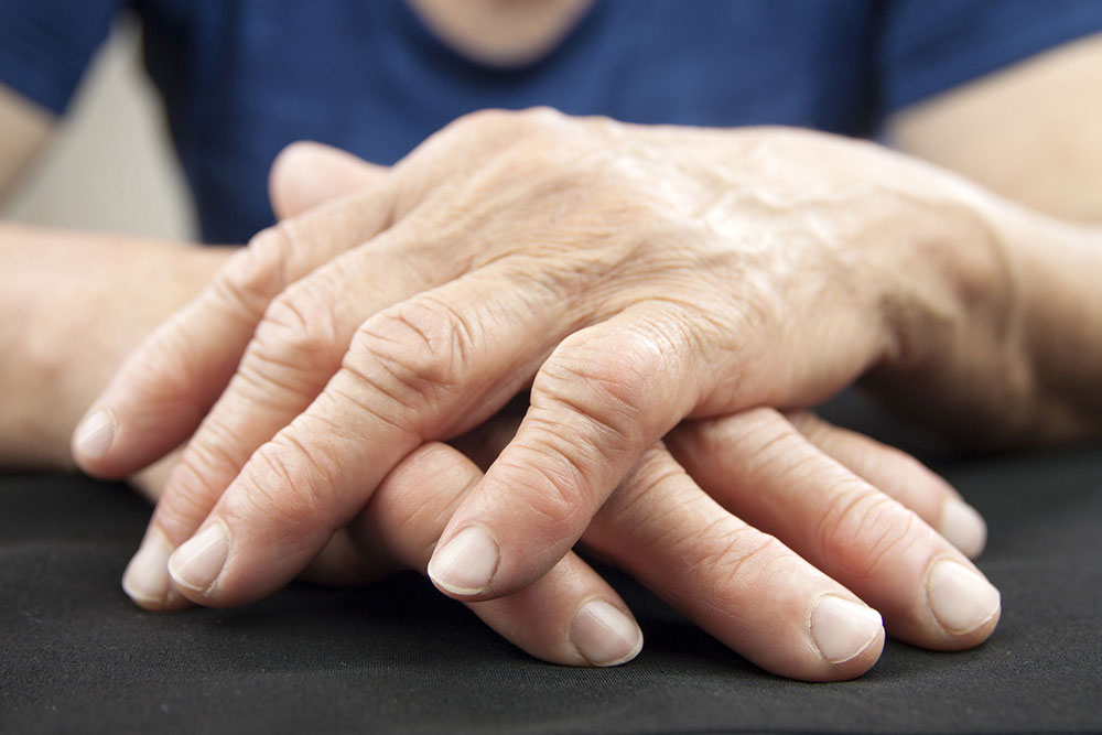 Top home remedies for rheumatoid arthritis