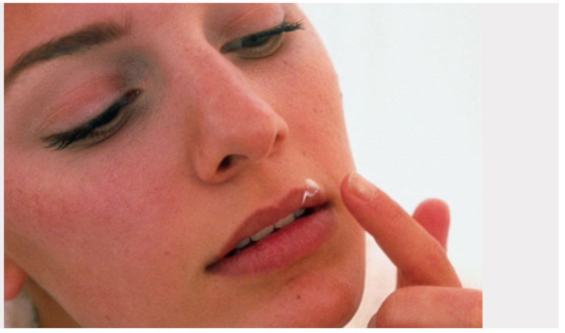 How to Prevent a Cold Sore